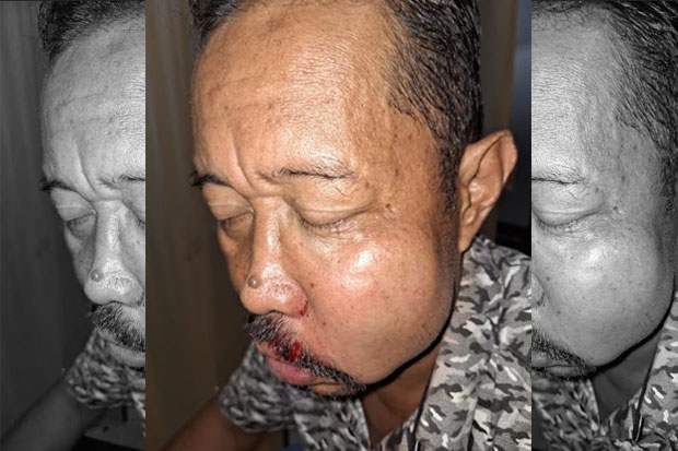 Anggota DPRD Perindo Luwu Utara Dipukul Warga hingga Bibir Sobek dan Pipi Bengkak