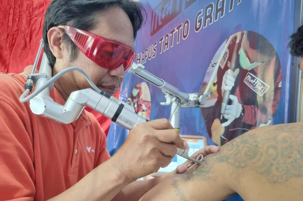 Setahun Kegiatan Hapus Tato Gratis Terhenti Akibat Kerusakan Mesin Laser